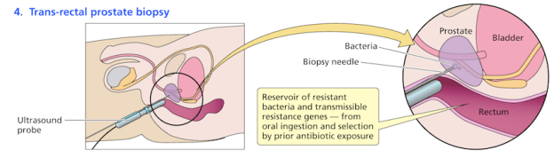trans rectal prostate